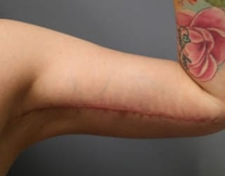 After Arm Lift Surgery Huntington Beach CA