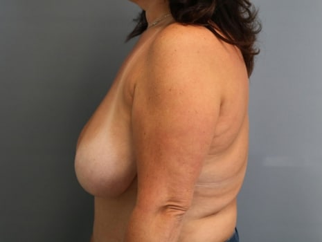 Before Image: Breast Reduction - left-side