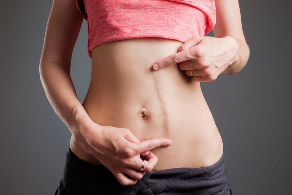 Image of woman pointing to large scar down her abdomen