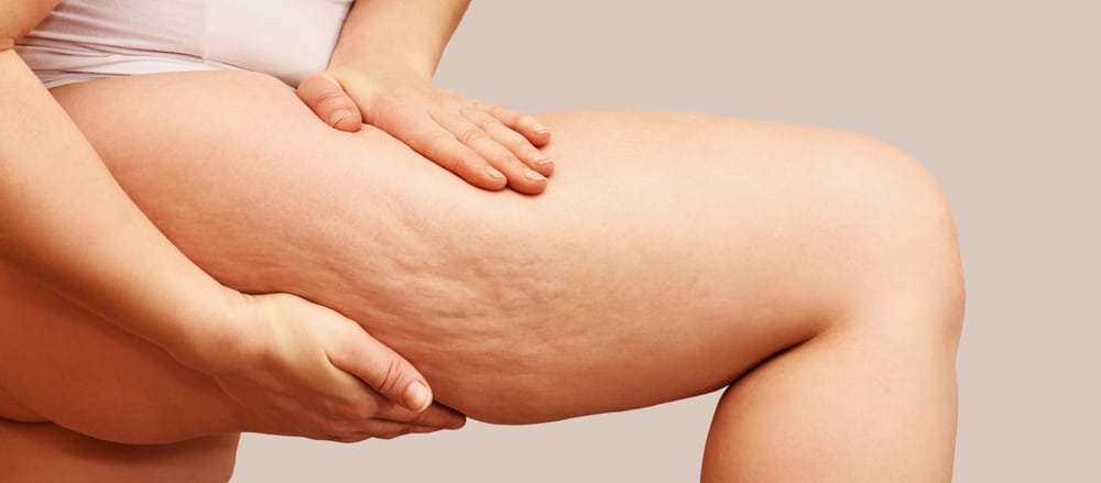 Avéli Cellulite Treatment Huntington Beach CA