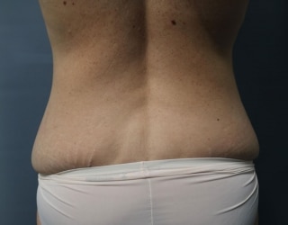 Before Liposuction Huntington Beach CA