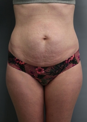 Before Mommy Makeover Huntington Beach CA