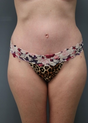 After Mommy Makeover Huntington Beach CA